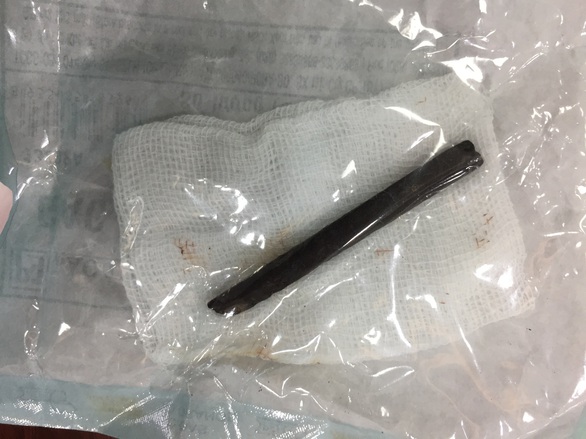 Khúc đũa 7cm nằm trong hốc mắt 4 năm dù đã nhiều lần đi khám - Ảnh 1. Khúc đũa 7cm nằm trong hốc mắt 4 năm dù đã nhiều lần đi khám - Ảnh 1.