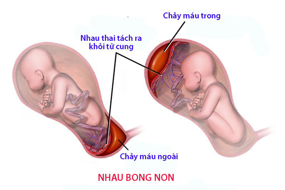 Tình trạng chảy máu khi mang thai - Ảnh 1. Tình trạng chảy máu khi mang thai - Ảnh 1.