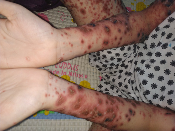Bé gái Việt Nam đầu tiên mắc bệnh chỉ 38 bệnh nhi thế giới mắc phải - Ảnh 1.