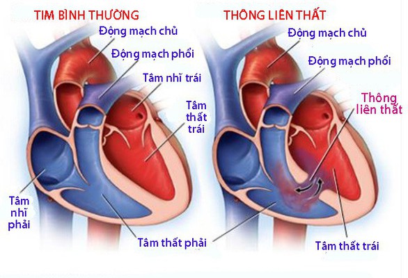 Dị tật thông liên thất - Ảnh 1. Dị tật thông liên thất - Ảnh 1.