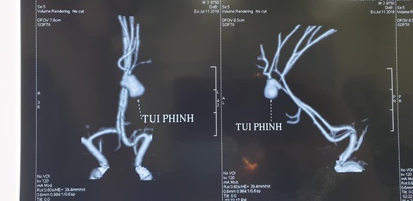 Bác sĩ kinh ngạc khi gặp ca phình mạch não vỡ ở trẻ 3 tuổi - Ảnh 1. Bác sĩ kinh ngạc khi gặp ca phình mạch não vỡ ở trẻ 3 tuổi - Ảnh 1.