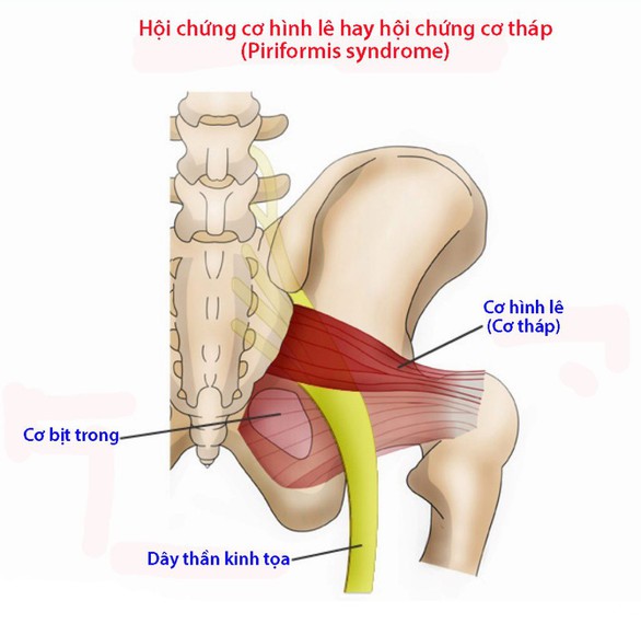 Hội chứng cơ hình lê - Ảnh 1. Hội chứng cơ hình lê - Ảnh 1.