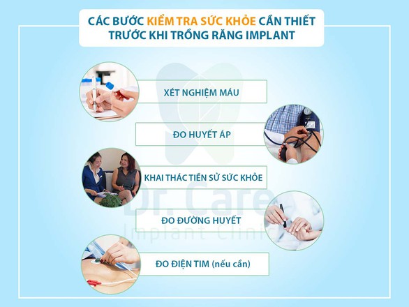 4 điều cần biết trước khi trồng răng Implant - Ảnh 2. 4 điều cần biết trước khi trồng răng Implant - Ảnh 2.