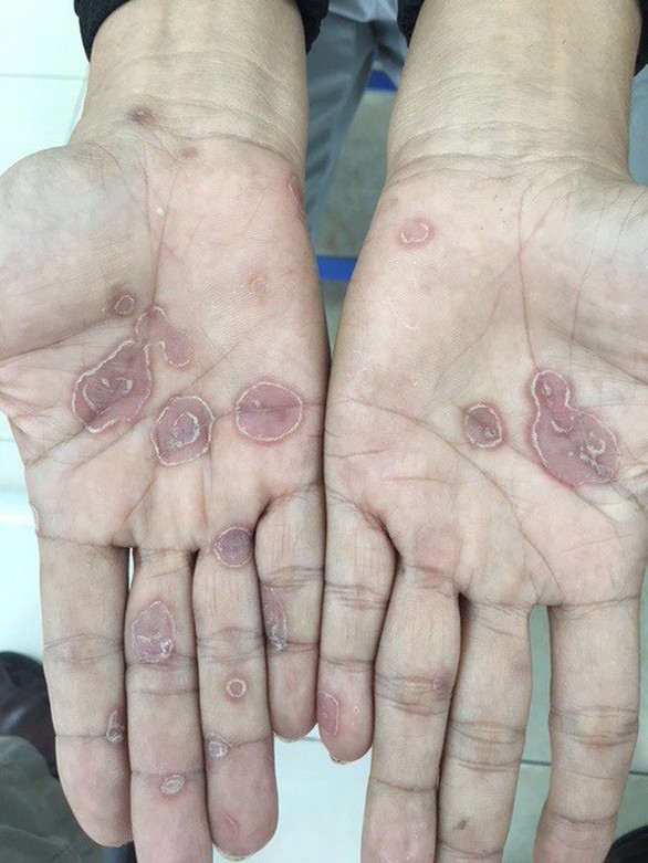 Bệnh nhân giang mai có em 13, có cụ 80 - Ảnh 1. Bệnh nhân giang mai có em 13, có cụ 80 - Ảnh 1.