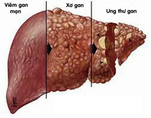 Hợp chất Fucoidan: Liệu pháp phòng ngừa ung thư mới - Ảnh 1. Hợp chất Fucoidan: Liệu pháp phòng ngừa ung thư mới - Ảnh 1.