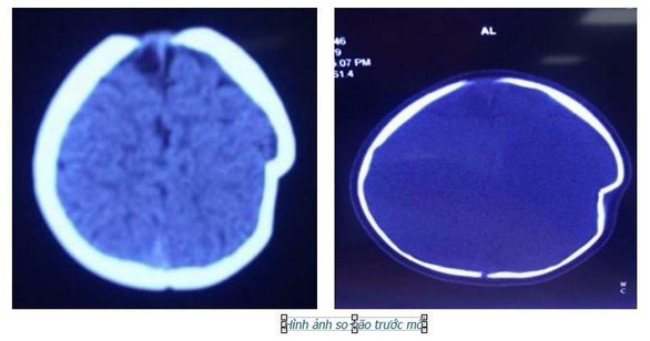 Em bé 8 tháng tuổi bị lún sọ vì xe tập đi - Ảnh 1. Em bé 8 tháng tuổi bị lún sọ vì xe tập đi - Ảnh 1.