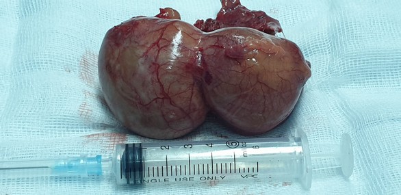 Phát hiện khối nang ngoài màng tim khủng - Ảnh 2. Phát hiện khối nang ngoài màng tim khủng - Ảnh 2.