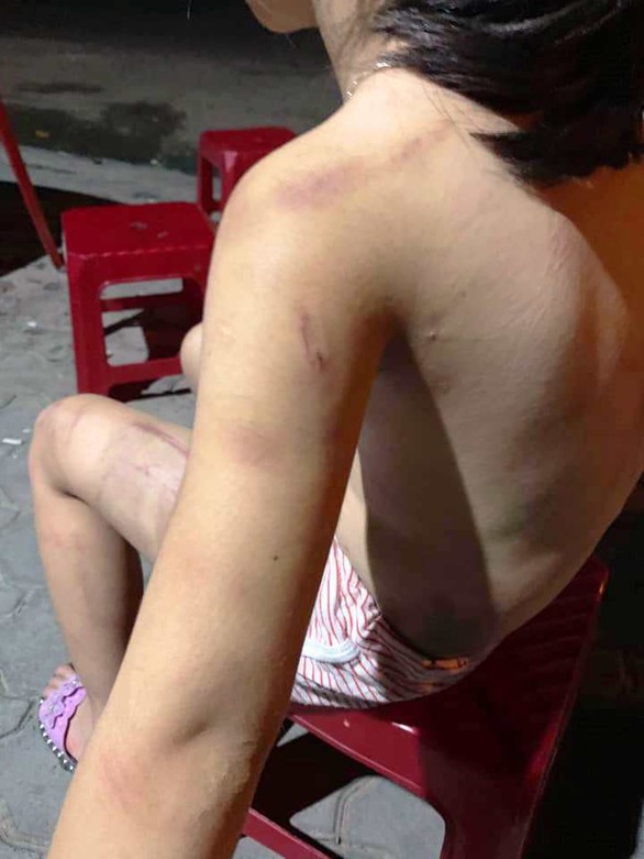 Xác minh vụ cháu bé 6 tuổi bị đánh lằn roi khắp người - Ảnh 2. Xác minh vụ cháu bé 6 tuổi bị đánh lằn roi khắp người - Ảnh 2.