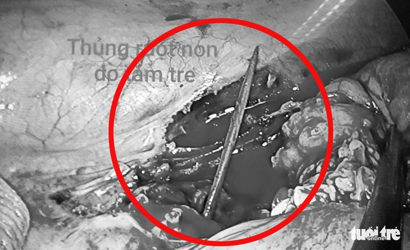 Cụ ông 72 tuổi bị tăm xỉa răng đâm thủng ruột - Ảnh 1. Cụ ông 72 tuổi bị tăm xỉa răng đâm thủng ruột - Ảnh 1.