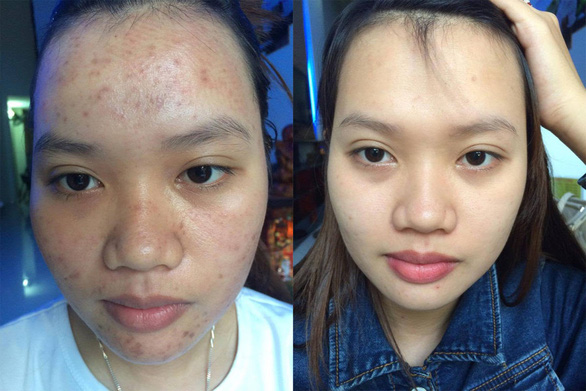 Tại sao nghệ đỏ trị thâm hiệu quả cao gấp nhiều lần nghệ vàng thông thường? - Ảnh 2. Tại sao nghệ đỏ trị thâm hiệu quả cao gấp nhiều lần nghệ vàng thông thường? - Ảnh 2.
