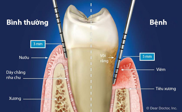 Men vi sinh nha khoa - giải pháp mới cho bệnh viêm nha chu - Ảnh 1.