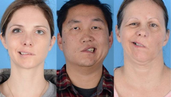 4 people had a distorted mouth after receiving the COVID-19 vaccine, what is the truth?  - Photo 1.