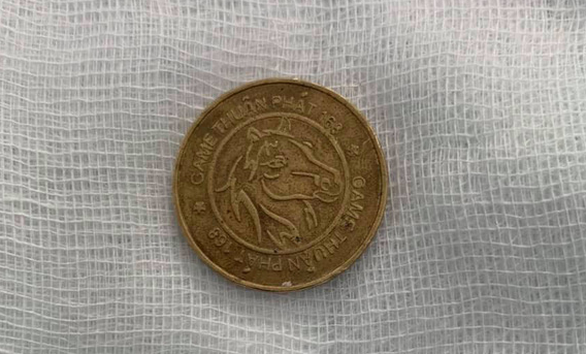 Gắp đồng xu ra khỏi thực quản bé trai 8 tuổi - Ảnh 1. Gắp đồng xu ra khỏi thực quản bé trai 8 tuổi - Ảnh 1.