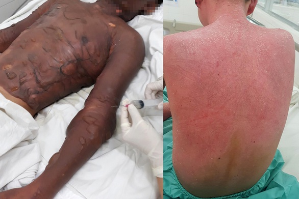 Giúp mẹ chiên đậu phụ bán, một thiếu niên 13 tuổi phỏng từ đầu đến thắt lưng - Ảnh 1. Giúp mẹ chiên đậu phụ bán, một thiếu niên 13 tuổi phỏng từ đầu đến thắt lưng - Ảnh 1.