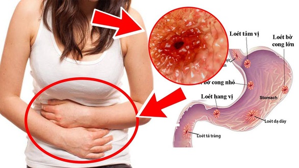 Vitos giảm nguy cơ biến chứng bệnh đau dạ dày - Ảnh 1. Vitos giảm nguy cơ biến chứng bệnh đau dạ dày - Ảnh 1.