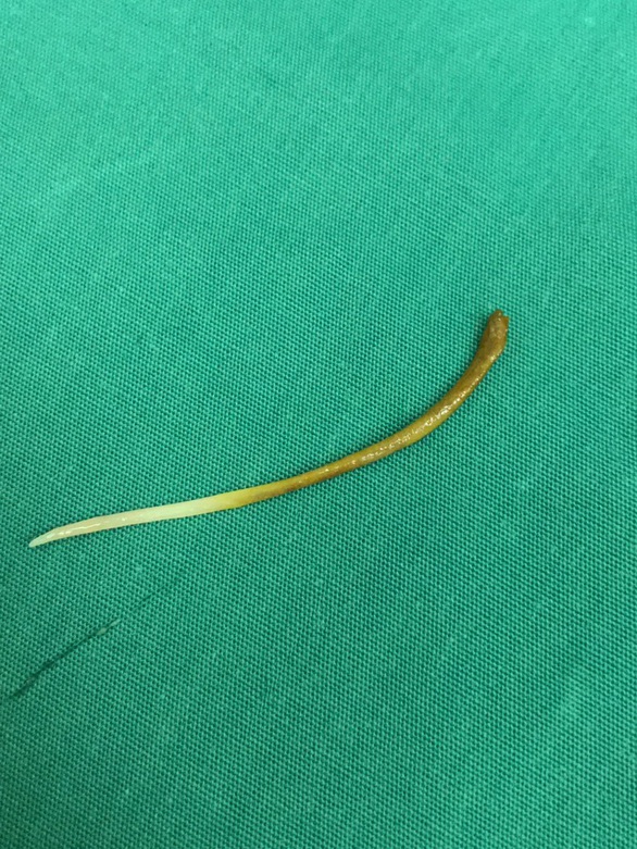 Bị xương cá 5cm đâm thủng ruột vì nghĩ xương sẽ tự tiêu - Ảnh 1. Bị xương cá 5cm đâm thủng ruột vì nghĩ xương sẽ tự tiêu - Ảnh 1.