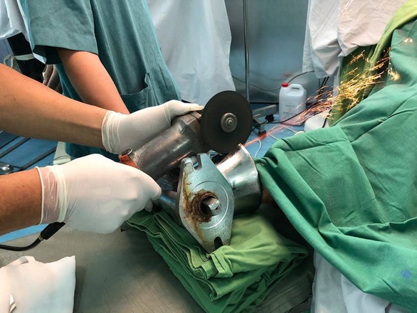 45 phút nghẹt thở cắt máy xay thịt để lấy bàn tay dập nát của một phụ nữ - Ảnh 3. 45 phút nghẹt thở cắt máy xay thịt để lấy bàn tay dập nát của một phụ nữ - Ảnh 3.