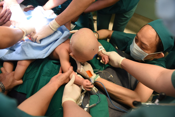 Gần 100 y bác sĩ bắt đầu ca đại phẫu 12 tiếng tách rời cặp song sinh phức tạp nhất Việt Nam - Ảnh 4.