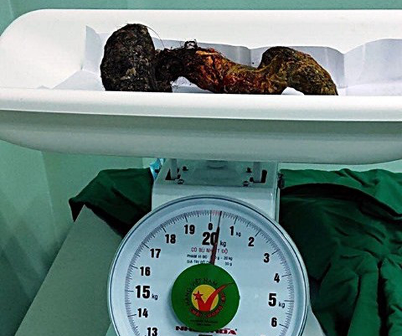 Mổ lấy gần nửa ký búi tóc trong bụng bé gái 10 tuổi - Ảnh 1. Mổ lấy gần nửa ký búi tóc trong bụng bé gái 10 tuổi - Ảnh 1.