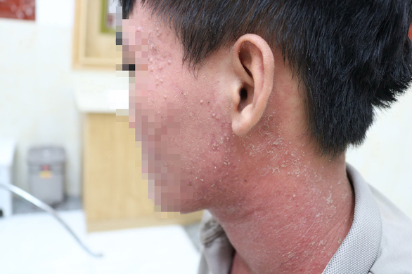 Tai biến mụn ở tuổi dậy thì - Ảnh 1. Tai biến mụn ở tuổi dậy thì - Ảnh 1.