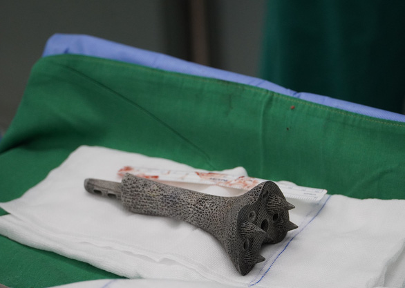 Bệnh viện Chợ Rẫy dùng Titanium in 3D trám lỗ hổng 11cm ở xương bệnh nhân ung thư - Ảnh 2.