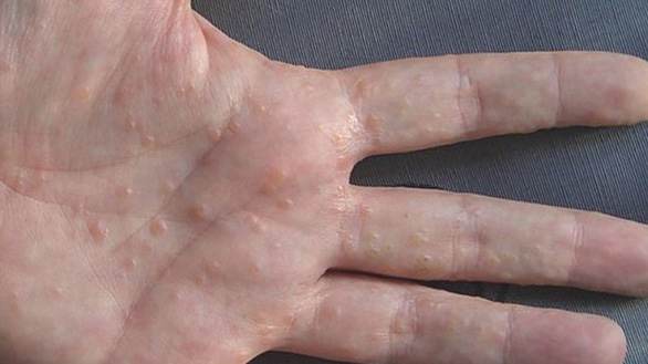 Lạm dụng nước rửa tay sát khuẩn có thể gây bệnh chàm tay - Ảnh 1.