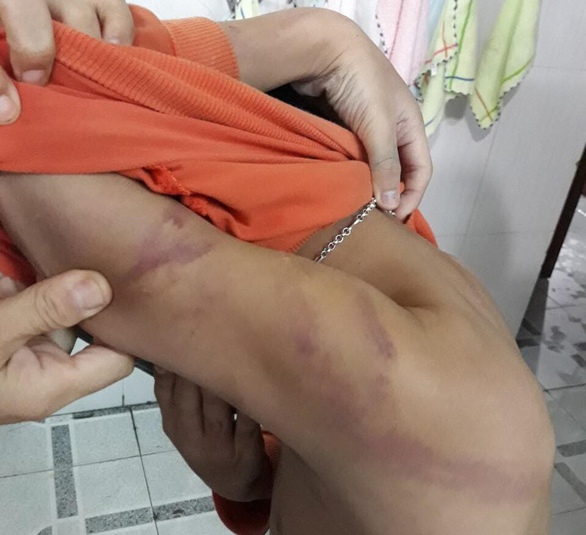 Xử phạt 1,5 triệu đồng người cha đánh con chằng chịt vết bầm tím - Ảnh 1. Xử phạt 1,5 triệu đồng người cha đánh con chằng chịt vết bầm tím - Ảnh 1.