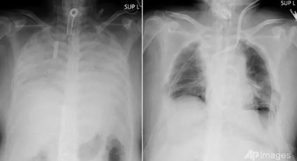 Lần đầu tiên trên thế giới: Ghép phổi từ 2 người sống cho bệnh nhân COVID-19 - Ảnh 1.