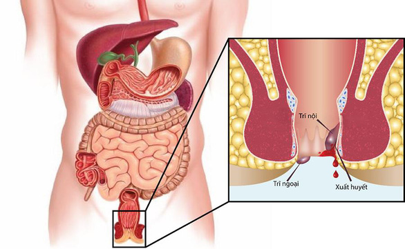 Triệu chứng bệnh trĩ và biện pháp phòng ngừa - Ảnh 1.