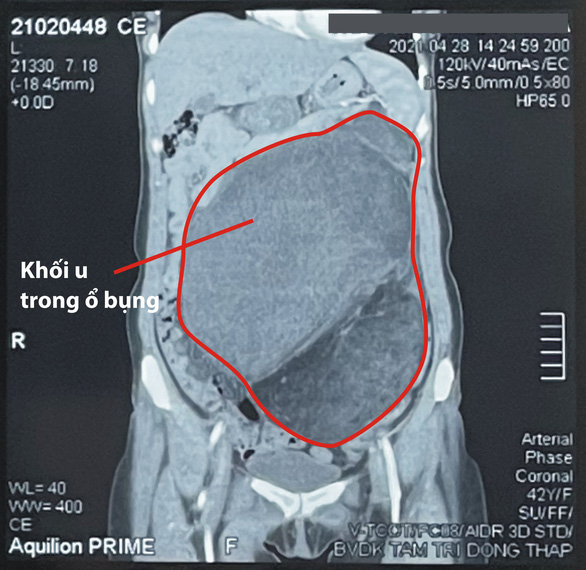 Phẫu thuật lấy khối u khổng lồ trong bụng - Ảnh 2.