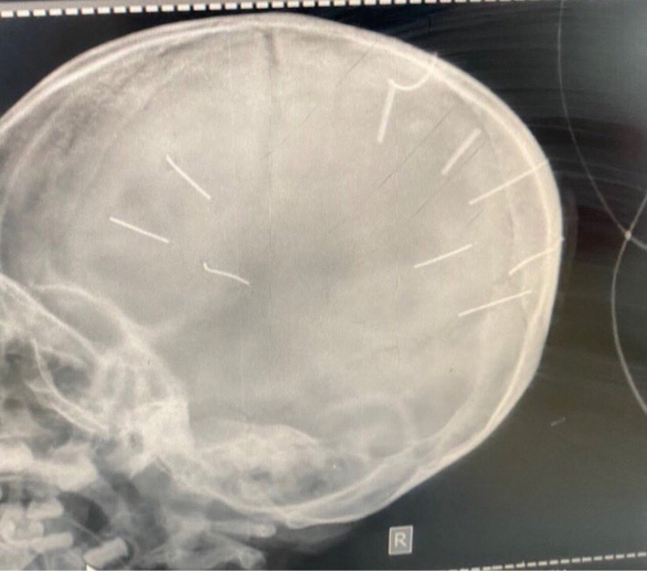 Bé gái 3 tuổi nhập viện, chụp X-quang thấy 9 vật thể giống đinh găm vào hộp sọ - Ảnh 1.