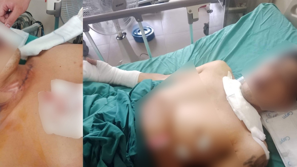 Bị dây diều cứa rách cổ khi đang chạy xe máy trên cầu Thủ Thiêm 1 - Ảnh 1. Bị dây diều cứa rách cổ khi đang chạy xe máy trên cầu Thủ Thiêm 1 - Ảnh 1.