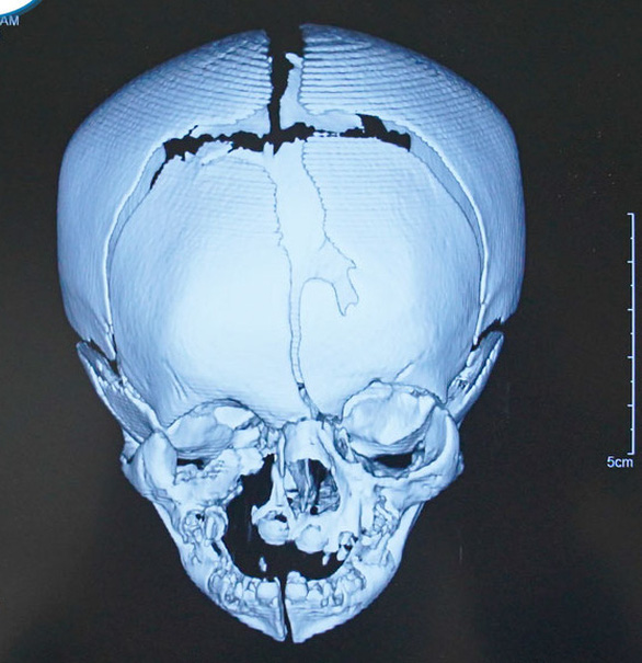 Phẫu thuật ‘lấy lại gương mặt’ cho bé sơ sinh 17 ngày tuổi - Ảnh 1.