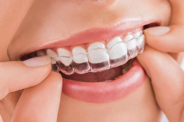 Phương pháp niềng răng trong suốt thu hút giới trẻ - Ảnh 1.