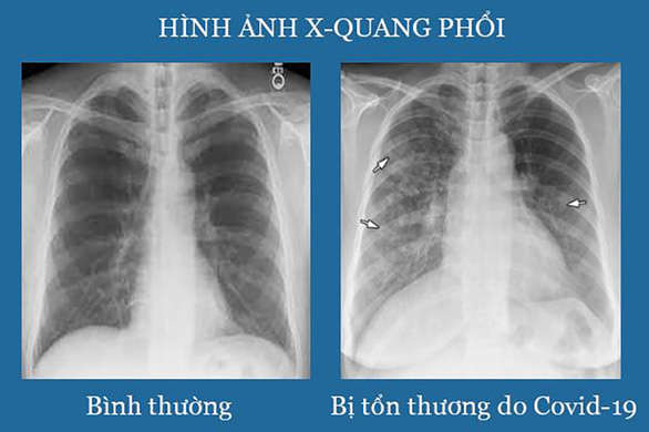 Tại sao nên phòng ngừa di chứng hậu COVID-19? - Ảnh 1.