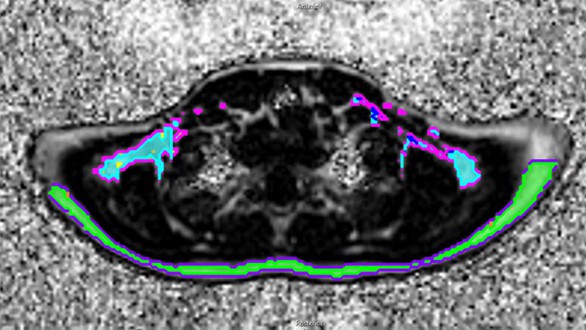 New discovery could help treat childhood obesity - Photo 2.