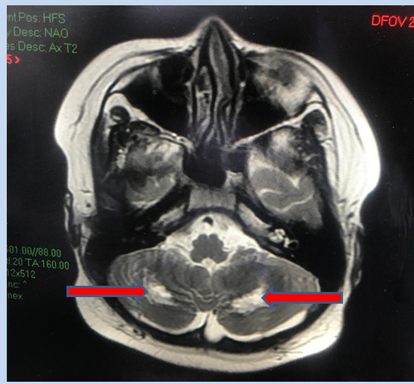 Sau khi khỏi COVID-19 nặng, bé trai bị tổn thương não vì mắc hội chứng viêm đa hệ thống - Ảnh 1.