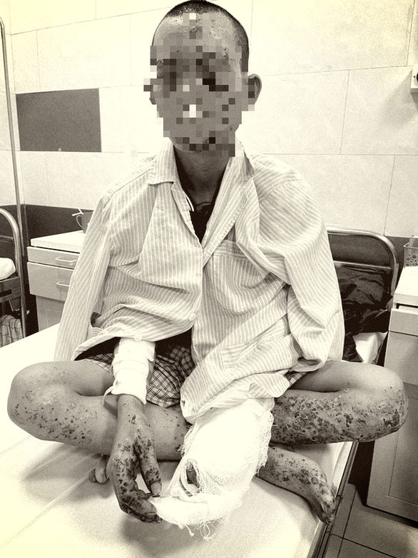 Cháy sém toàn thân, nguy cơ mù mắt vì dùng điện thoại khi sạc - Ảnh 1. Cháy sém toàn thân, nguy cơ mù mắt vì dùng điện thoại khi sạc - Ảnh 1.