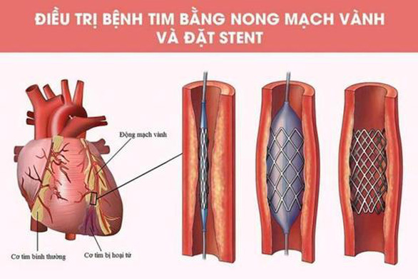Thông tin cần biết về nhồi máu cơ tim cấp - Ảnh 2.