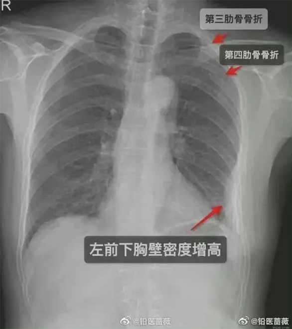 Cô gái bị gãy xương vì đồng nghiệp nam... ôm - Ảnh 1. Cô gái bị gãy xương vì đồng nghiệp nam... ôm - Ảnh 1.
