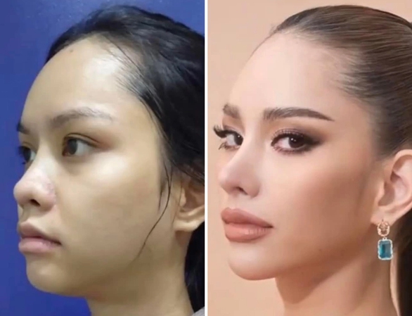 Netizen cười cợt hình ảnh chưa dao kéo của tân Hoa hậu Hoàn vũ Thái Lan - Ảnh 1. Netizen cười cợt hình ảnh chưa dao kéo của tân Hoa hậu Hoàn vũ Thái Lan - Ảnh 1.