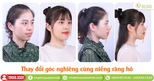 Nha khoa VIET SMILE - Niềng răng mắc cài thấy trước kết quả - Ảnh 1.