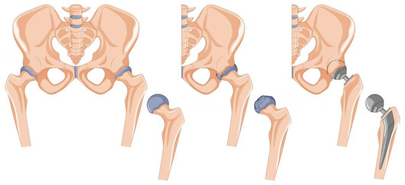 Bác sĩ hướng dẫn cách phục hồi vận động sau phẫu thuật thay khớp háng nhân tạo - Ảnh 1.