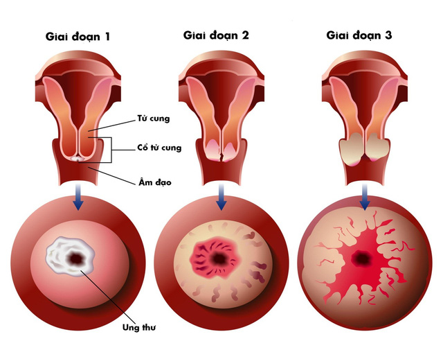 Những câu hỏi thường gặp về chụp Xquang tử cung  vòi trứng