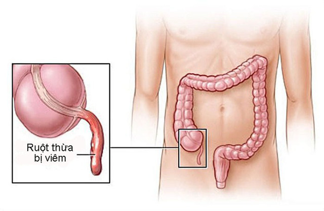 Bệnh Viêm Ruột Thừa Ở Trẻ Em: Nguyên Nhân, Triệu Chứng Và Cách Điều Trị Hiệu Quả