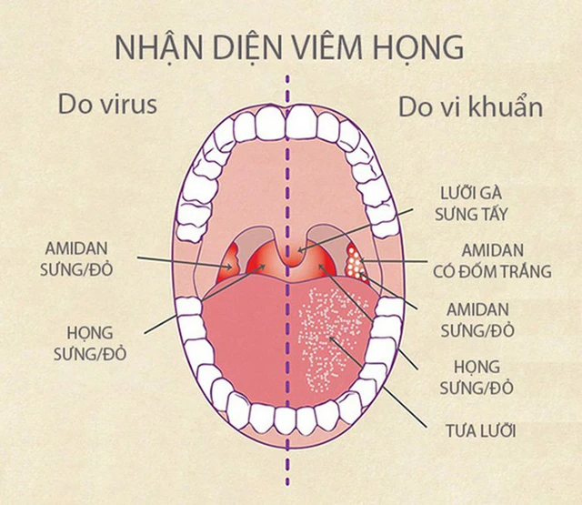 Bệnh viêm họng mùa lạnh - Ảnh 1.