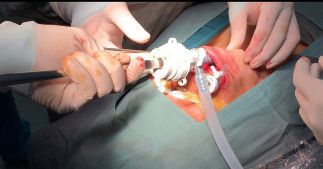Phẫu thuật nội soi tuyến giáp qua đường miệng không để lại sẹo - Ảnh 1.