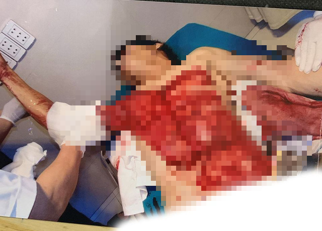 Dốc toàn lực cứu chữa nạn nhân tai nạn thương tâm do máy bóc gỗ - Ảnh 1.