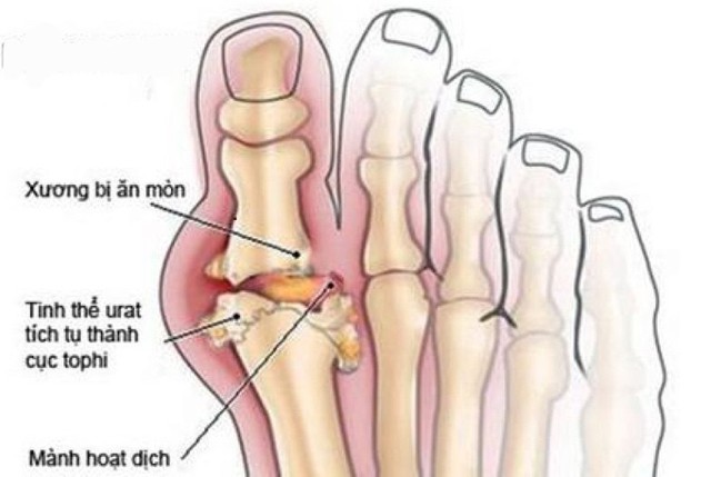 Có phòng ngừa tái phát bệnh gout được không? - Ảnh 1.