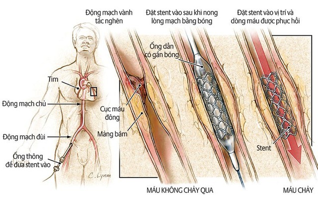 Can thiệp động mạch vành là gì? - Ảnh 1.